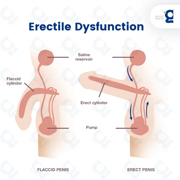 erectile dysfunction